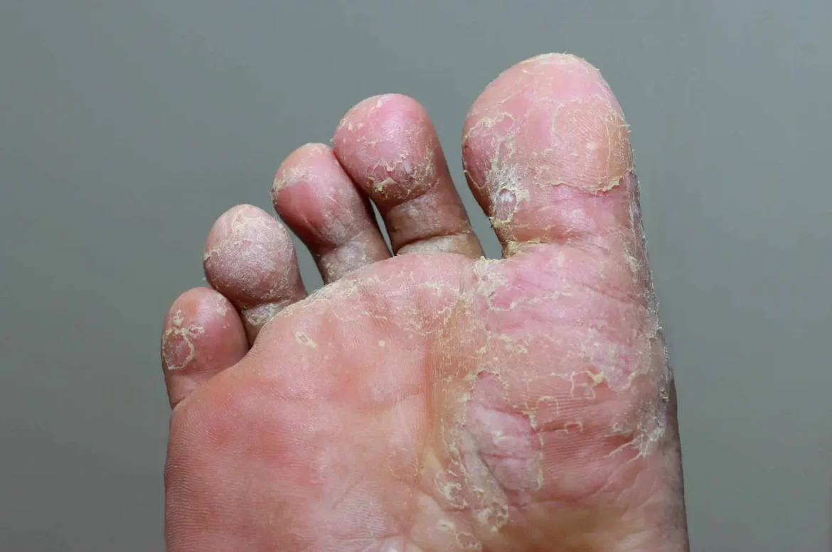 Foot Fungus Prevention Tips की समस्या गर्मी और बरसात में आम हो जाती है। जानिए मॉनसून से पहले पैरों की देखभाल के जरूरी और आसान उपाय जिससे बचा जा सकता है फंगल इन्फेक्शन से।